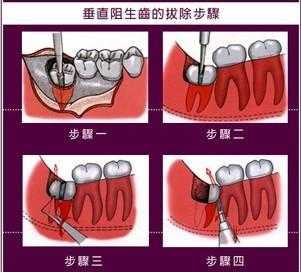 怀孕期间能不能拔牙,备孕期能拔牙吗智齿 第2张 怀孕期间能不能拔牙,备孕期能拔牙吗智齿 第2张