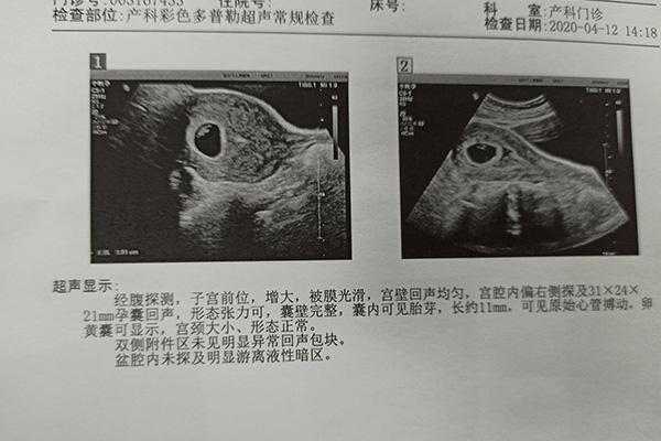 医生说胎儿头大(医生说胎儿头大是暗示男孩还是女孩) 第2张 医生说胎儿头大(医生说胎儿头大是暗示男孩还是女孩) 第2张