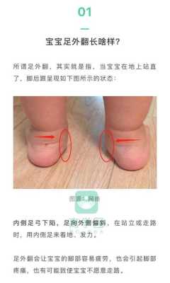 胎儿足外翻(宝宝的脚有点足外翻,去医院看应该看那个科) 第1张 胎儿足外翻(宝宝的脚有点足外翻,去医院看应该看那个科) 第1张