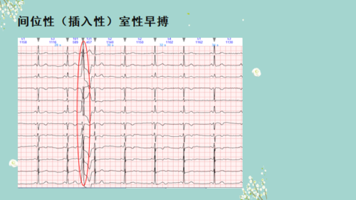 胎儿房性早搏(胎儿房性早搏) 第2张 胎儿房性早搏(胎儿房性早搏) 第2张