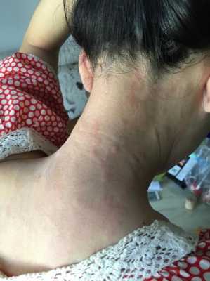 孕妇身上很痒是怎么回事,孕期身上痒怎么回事儿 第2张 孕妇身上很痒是怎么回事,孕期身上痒怎么回事儿 第2张