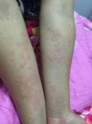 孕妇身上很痒是怎么回事,孕期身上痒怎么回事儿 第1张 孕妇身上很痒是怎么回事,孕期身上痒怎么回事儿 第1张
