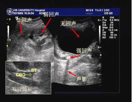 双肾实质及窦区点片状强回声什么意思,胎儿双肾回声增强是什么意思 第1张 双肾实质及窦区点片状强回声什么意思,胎儿双肾回声增强是什么意思 第1张