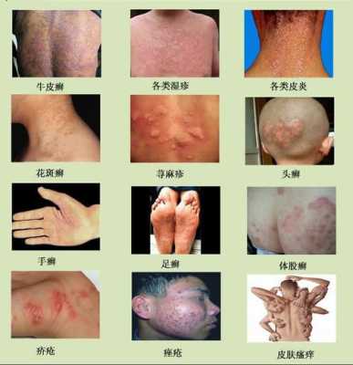 孕期起湿疹怎么办(孕妇阴部得了湿疹怎么办) 第2张 孕期起湿疹怎么办(孕妇阴部得了湿疹怎么办) 第2张