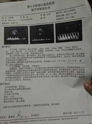 胎儿心跳180（胎儿心跳180正常吗）  第2张