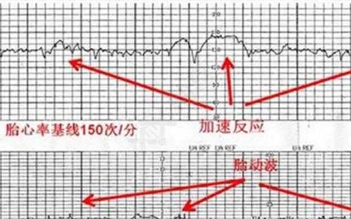 胎儿心率140次/分正常吗,胎儿心率140是男孩还是女孩 第2张 胎儿心率140次/分正常吗,胎儿心率140是男孩还是女孩 第2张