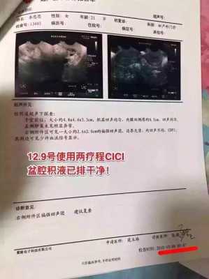 孕期盆腔积液怎么办(孕期盆腔积液怎么办,还有炎症怎么治疗) 第2张 孕期盆腔积液怎么办(孕期盆腔积液怎么办,还有炎症怎么治疗) 第2张