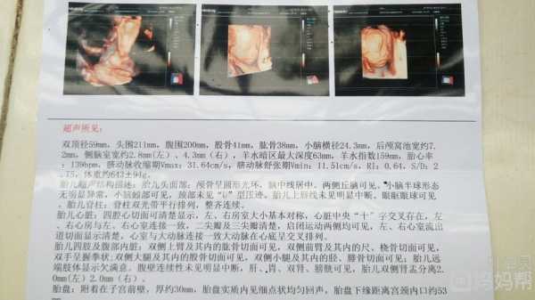 胎儿神经管缺陷(胎儿神经管缺陷做什么检查) 第1张 胎儿神经管缺陷(胎儿神经管缺陷做什么检查) 第1张