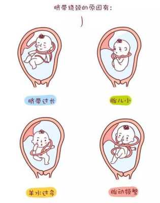 胎儿脐带短(胎儿脐带短是什么原因造成的) 第2张 胎儿脐带短(胎儿脐带短是什么原因造成的) 第2张