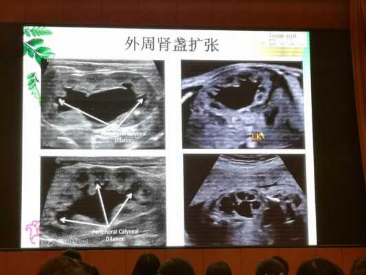 胎儿左肾集合系统分离是怎么回事,胎儿左肾肾盂分离什么意思 第2张 胎儿左肾集合系统分离是怎么回事,胎儿左肾肾盂分离什么意思 第2张