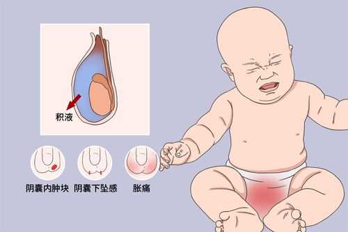 胎儿鞘膜积液(胎儿鞘膜积液是什么原因造成的) 第1张 胎儿鞘膜积液(胎儿鞘膜积液是什么原因造成的) 第1张