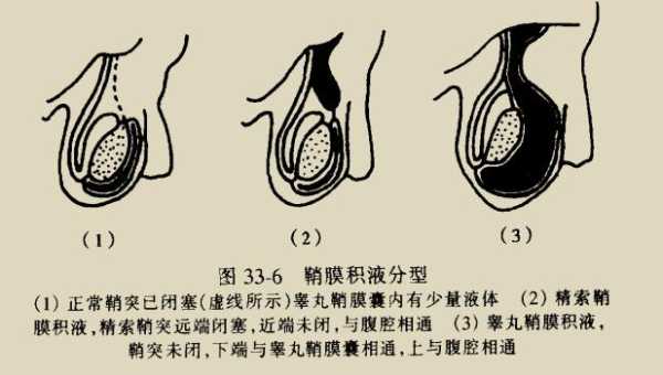 胎儿鞘膜积液(胎儿鞘膜积液是什么原因造成的) 第2张 胎儿鞘膜积液(胎儿鞘膜积液是什么原因造成的) 第2张