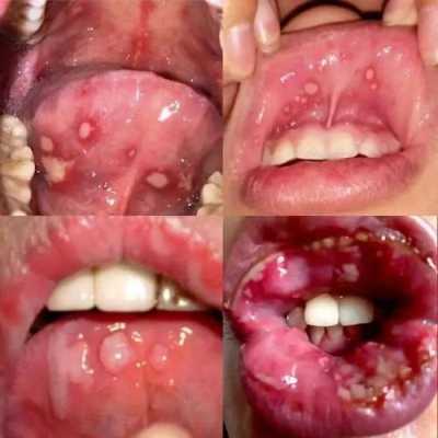 孕妇牙龈肿痛怎么办,孕期牙龈发炎怎么办很痛 第1张 孕妇牙龈肿痛怎么办,孕期牙龈发炎怎么办很痛 第1张