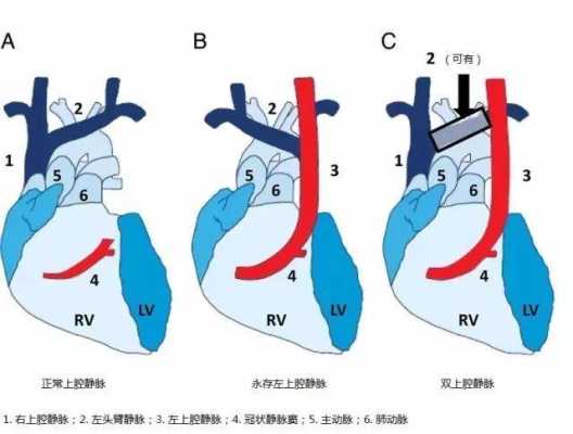 胎儿永存左上腔(永存左上腔静脉是什么意思啊) 第2张 胎儿永存左上腔(永存左上腔静脉是什么意思啊) 第2张
