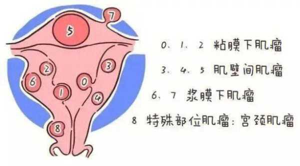 孕期发现子宫肌瘤(妊娠合并子宫肌瘤怎么治疗) 第2张 孕期发现子宫肌瘤(妊娠合并子宫肌瘤怎么治疗) 第2张