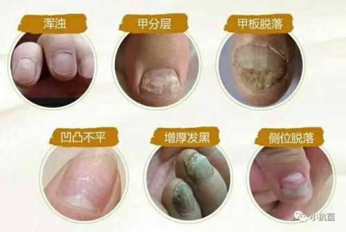 孕期灰指甲怎么办(孕妇有灰指甲怎么办?) 第1张 孕期灰指甲怎么办(孕妇有灰指甲怎么办?) 第1张