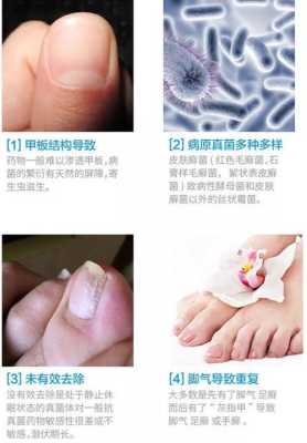 孕期灰指甲怎么办(孕妇有灰指甲怎么办?) 第3张 孕期灰指甲怎么办(孕妇有灰指甲怎么办?) 第3张