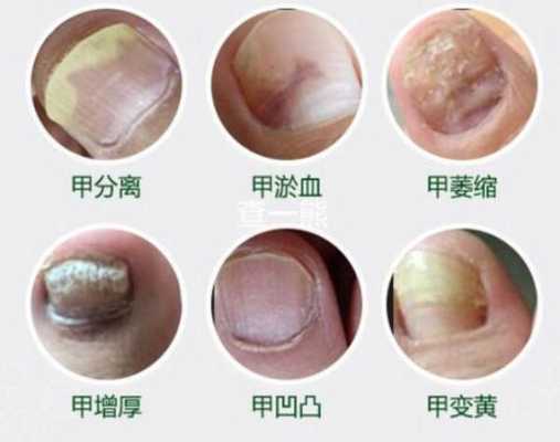 孕期灰指甲怎么办(孕妇有灰指甲怎么办?) 第2张 孕期灰指甲怎么办(孕妇有灰指甲怎么办?) 第2张