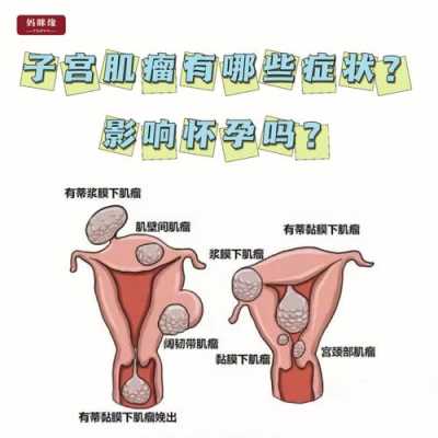 子宫肌瘤影响胎儿吗(孕妇子宫肌瘤影响胎儿吗) 第1张 子宫肌瘤影响胎儿吗(孕妇子宫肌瘤影响胎儿吗) 第1张