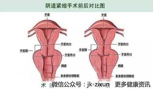 孕期阴道松弛(孕期阴道松弛) 第2张 孕期阴道松弛(孕期阴道松弛) 第2张
