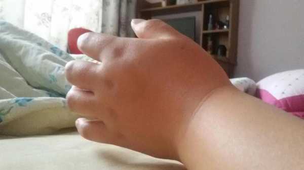 孕期腕管综合症(孕30周了,手肿麻木正常吗) 第2张 孕期腕管综合症(孕30周了,手肿麻木正常吗) 第2张