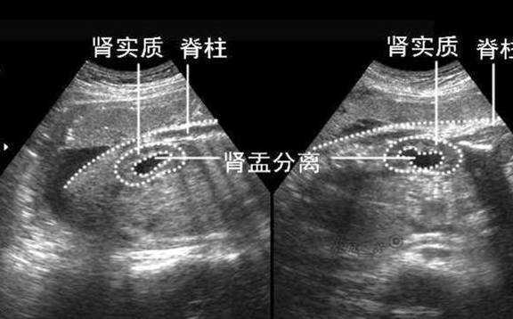 B超显示胎儿肾盂分离,怎么回事,胎儿右侧肾盂分离什么意思 第1张 B超显示胎儿肾盂分离,怎么回事,胎儿右侧肾盂分离什么意思 第1张