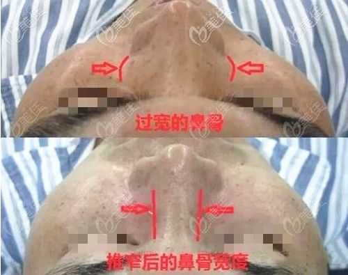 鼻梁骨短怎么办,胎儿鼻骨偏短会导致什么  第2张