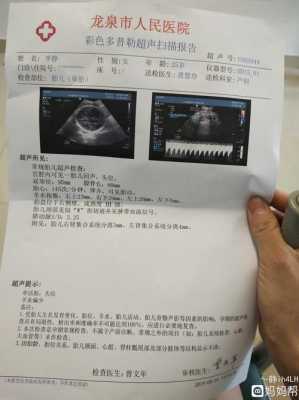 胎儿颈部w型压迹(胎儿颈部U形压迹是什么意思) 第2张 胎儿颈部w型压迹(胎儿颈部U形压迹是什么意思) 第2张