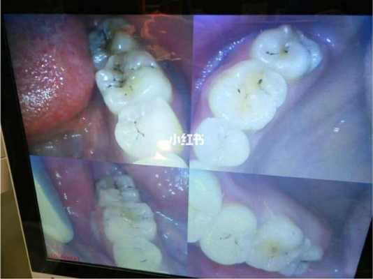 孕妇能补牙齿吗,孕期能不能补牙洞 第2张 孕妇能补牙齿吗,孕期能不能补牙洞 第2张
