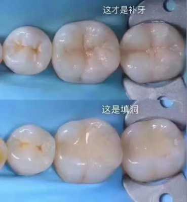 孕妇能补牙齿吗,孕期能不能补牙洞 第1张 孕妇能补牙齿吗,孕期能不能补牙洞 第1张