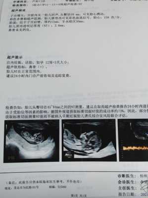 胎儿鼻骨发育不良(怀孕产检,nt检查结果看不到鼻骨咋办,胎儿会不会有问题呢) 第2张 胎儿鼻骨发育不良(怀孕产检,nt检查结果看不到鼻骨咋办,胎儿会不会有问题呢) 第2张
