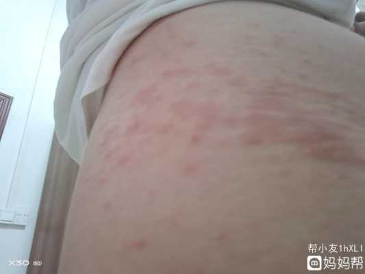 过敏对胎儿有影响吗(孕妇吃虾过敏对胎儿有影响吗) 第1张 过敏对胎儿有影响吗(孕妇吃虾过敏对胎儿有影响吗) 第1张