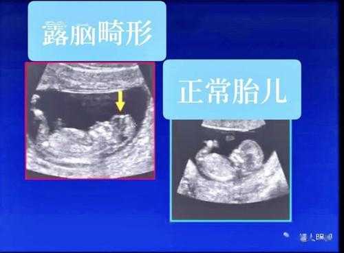 胎儿的颅骨（胎儿的颅骨是圆形的还是椭圆形的）  第2张