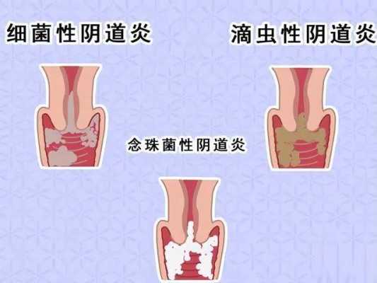 孕期滴虫性阴道炎(孕期有滴虫性阴炎怎么治疗) 第1张 孕期滴虫性阴道炎(孕期有滴虫性阴炎怎么治疗) 第1张