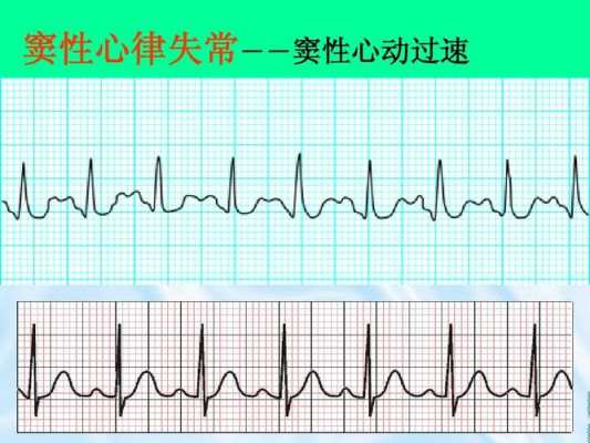 孕妇窦性心律过速110是不是属于正常的啊,孕期窦性心动过速是怎么回事 第2张 孕妇窦性心律过速110是不是属于正常的啊,孕期窦性心动过速是怎么回事 第2张