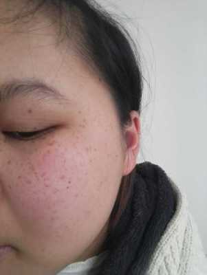孕期脸上长斑怎么办(孕期长斑怎么回事) 第1张 孕期脸上长斑怎么办(孕期长斑怎么回事) 第1张
