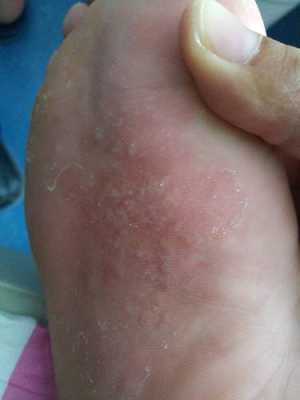 孕期脚底痒怎么回事(孕妇脚痒特别是晚上越抓越痒) 第2张 孕期脚底痒怎么回事(孕妇脚痒特别是晚上越抓越痒) 第2张