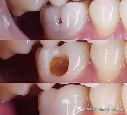孕期能补牙吗,孕期补牙齿可以吗  第3张