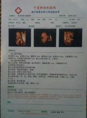 胎儿双肾可见(胎儿双肾轻度积水怎么办) 第3张 胎儿双肾可见(胎儿双肾轻度积水怎么办) 第3张