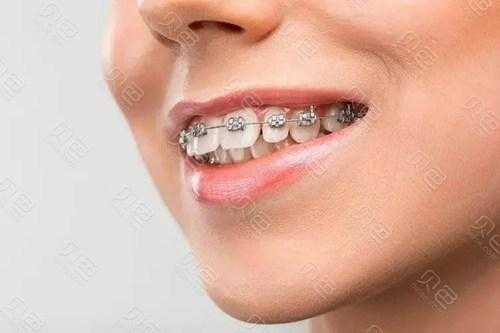 孕期可以矫正牙齿吗(孕期可以矫正牙齿吗?) 第3张 孕期可以矫正牙齿吗(孕期可以矫正牙齿吗?) 第3张