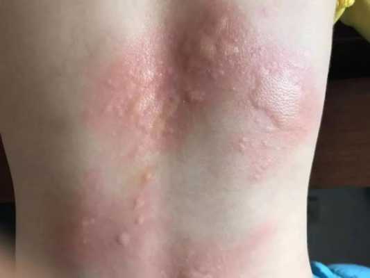 荨麻疹影响胎儿吗（荨麻疹影响胎儿吗）  第2张