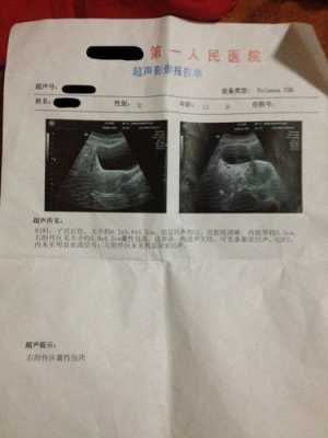 怀孕了右侧附件区囊肿怎么办,胎儿有囊肿是什么原因造成的 第2张 怀孕了右侧附件区囊肿怎么办,胎儿有囊肿是什么原因造成的 第2张
