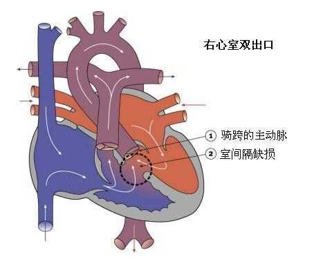 胎儿右室双出口（胎儿右室双出口是什么原因造成的）  第1张
