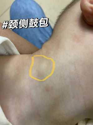 胎儿在鼓包(胎儿在鼓包是什么部位) 第2张 胎儿在鼓包(胎儿在鼓包是什么部位) 第2张