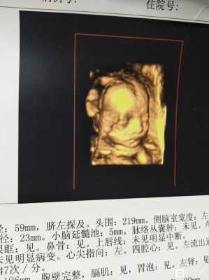 5个月胎儿彩超(5个月胎儿彩超图片) 第1张 5个月胎儿彩超(5个月胎儿彩超图片) 第1张