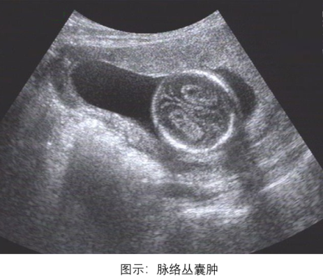 4个月胎儿左侧脉络丛囊肿,脉络丛胎儿出生后遗症 第2张 4个月胎儿左侧脉络丛囊肿,脉络丛胎儿出生后遗症 第2张