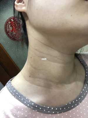 孕期长颈纹怎么办(妊娠纹是横纹还是竖纹) 第1张 孕期长颈纹怎么办(妊娠纹是横纹还是竖纹) 第1张