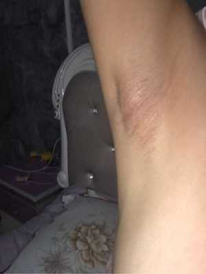 怀孕以后腋窝长了一个肉疙瘩是怎么回事,孕期腋下淋巴结肿大疼痛怎么办 第2张 怀孕以后腋窝长了一个肉疙瘩是怎么回事,孕期腋下淋巴结肿大疼痛怎么办 第2张