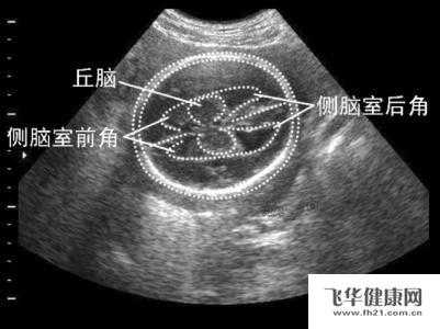 胎儿脑宽（胎儿脑宽是什么意思）  第2张