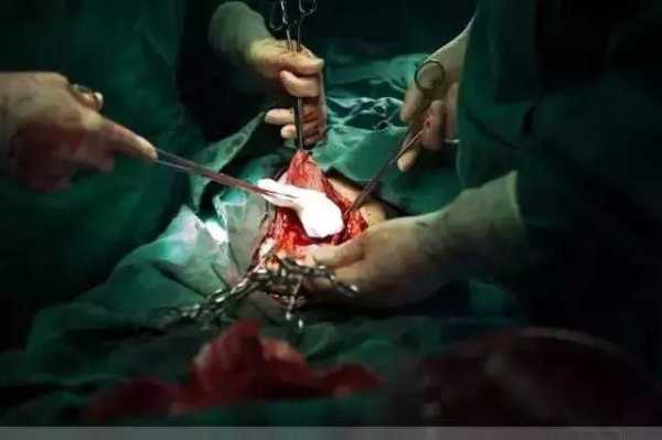 剖腹产的胎儿(剖腹产阴道口会扩张吗) 第1张 剖腹产的胎儿(剖腹产阴道口会扩张吗) 第1张